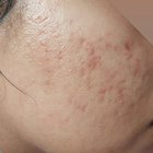 Thumbnail of www-reddit-com-r-skincareaddiction-comments-w1zgko-acne-how-can-i-get-rid-of-my-acne-scarring 0
