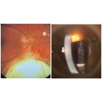 Thumbnail of Fridays patient: most common associated complications with ...
