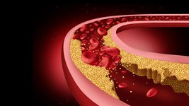 Thumbnail of Cleveland Clinic First-In-Human Trial of CRISPR Gene-Editing Therapy Shown to Safely Lower Cholesterol and Triglycerides